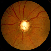 При глаукоме диск зрительного нерва приобретает сероватый оттенок.